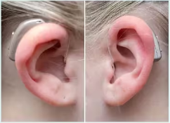 CROS / BiCROS dual ear fitting